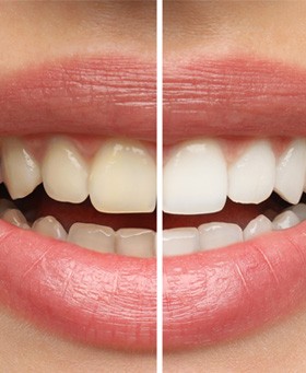 Closeup of patient's smile before and after teeth whitening