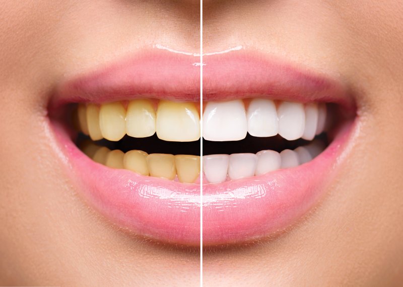 A before-and-after shot of teeth whitening treatment